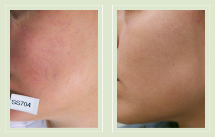 spider veins on face treatment at home