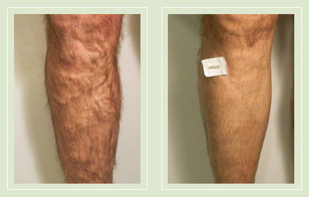 Before and after pic EVLT Mini Phlebectomy leg varicose vein