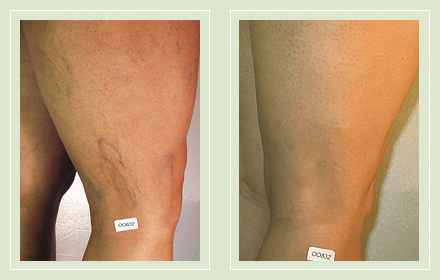 before after pictures varicose vein leg treatment 8