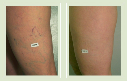 before after pictures varicose spider vein leg treatment 9