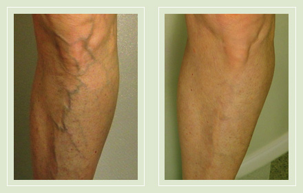 Before and After pic reticular spider leg vein sclerotherapy 64yo