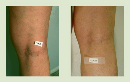 Before and after pics spider vein leg sclerotherapy