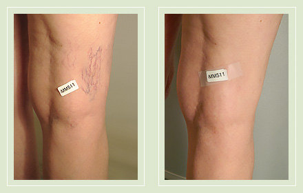 Before and After pics-leg spider vein sclerotherapy 46yo