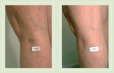 Before and after pics-leg spider reticular vein sclerotherapy 53yo