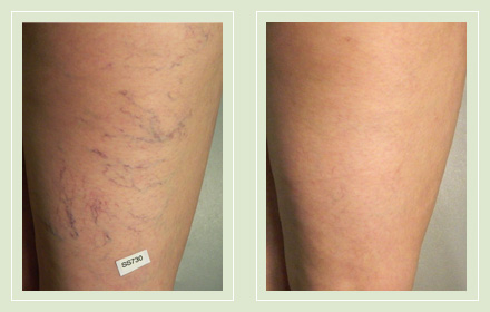 before after pictures spider vein leg treatment 4