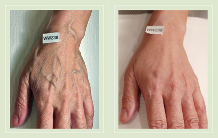 varicose-hand-vein-removal-before-after-pics-10