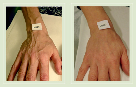 varicose-hand-vein-removal-before-after-pics-4