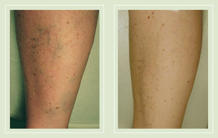 before after pictures varicose vein treatment legs 12