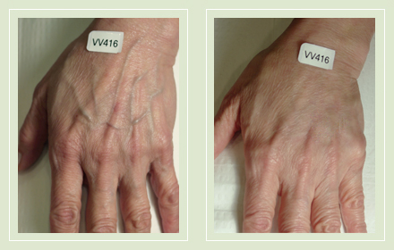 hand-vein-removal-before-after-pics-1