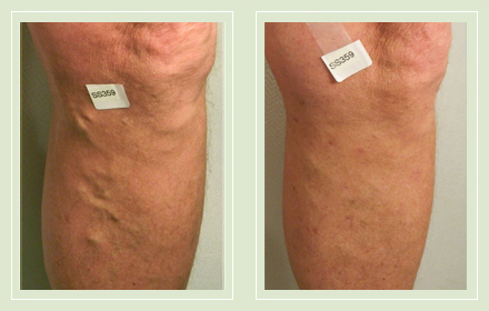 before after pictures varicose vein leg treatment 11