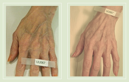 hand-vein-removal-before-after-pics-10