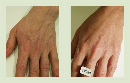 varicose-hand-vein-removal-before-after-pics-2