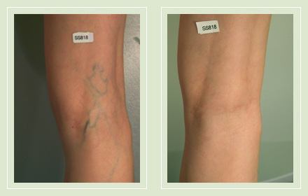 before after pictures varicose vein leg treatment 1