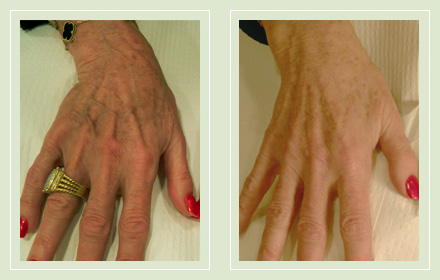 hand-vein-removal-before-after-pics-6