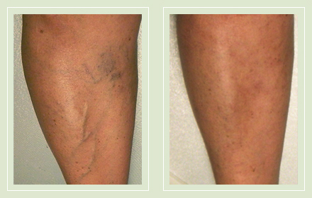 before after pictures varicose vein leg treatment 10