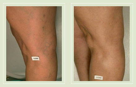 before after pictures varicose vein treatment legs 14