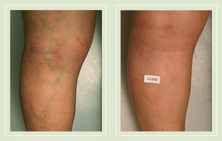 before after pictures varicose vein leg treatment 6