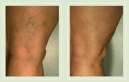 before after pictures varicose vein treatment legs 13
