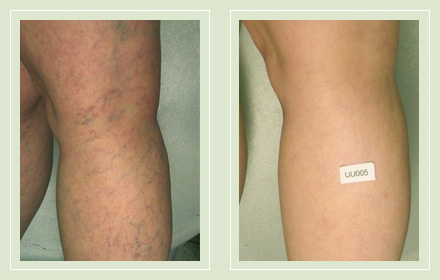 before after pictures varicose vein leg treatment 2