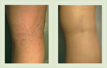 Before and after pic spider vein leg sclerotherapy 34yo