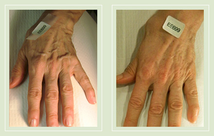hand-vein-removal-before-after-pics-4