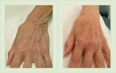 varicose-hand-vein-removal-before-after-pics-1