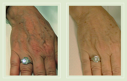 varicose-hand-vein-removal-before-after-pics-7