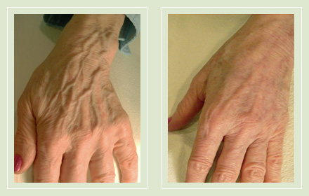 hand-vein-removal-before-after-pics-7