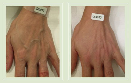 varicose-hand-vein-removal-before-after-pics-9