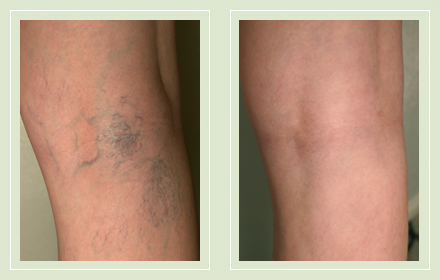 Before and After pictures Spider Vein leg Sclerotherapy