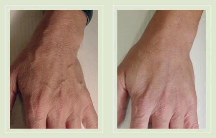 hand-vein-removal-before-after-pics-2