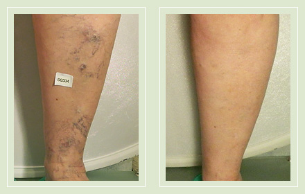 Before and After legs spider reticular sclerotherapy 68yo