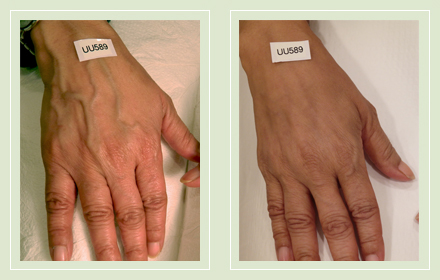 varicose-hand-vein-removal-before-after-pics-6