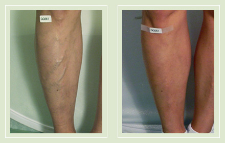 before after pictures varicose vein leg treatment