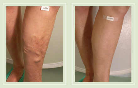 Before and After pictures varicose vein leg sclerotherapy