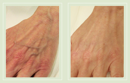 hand-vein-removal-before-after-pics-8
