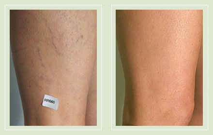 Before and after pics spider leg vein sclerotherapy 43yo