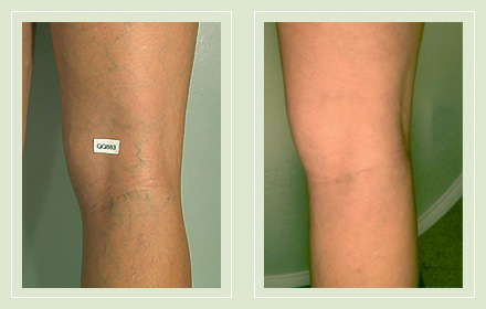 Before and after pic leg reticular spider vein sclerotherapy 48yo