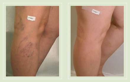 Before and after pics-spider vein sclerotherapy