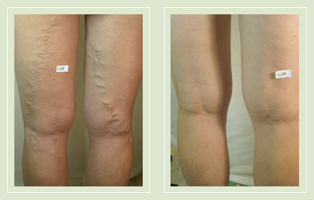 before after pictures varicose vein treatment legs-20