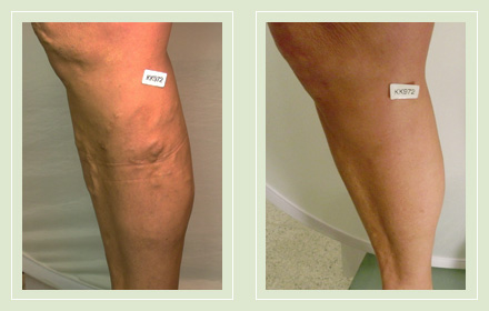 Before and After pics-Varicose Vein EVLT Mini Phlebectomy