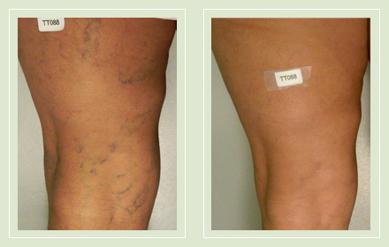 Before and after pic leg reticular spider vein sclerotherapy 56yo