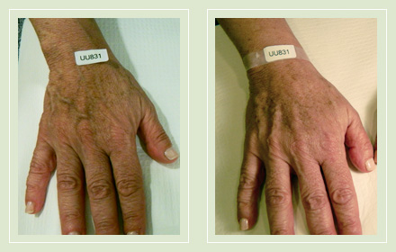 hand-vein-removal-before-after-pics-5