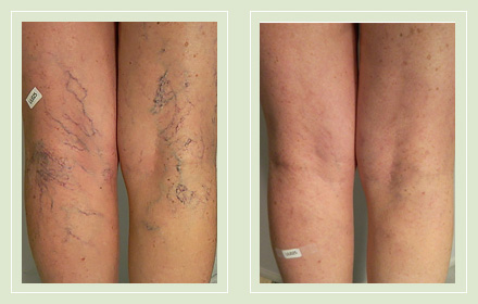 Before and after pic leg spider reticular vein sclerotherapy 61yo