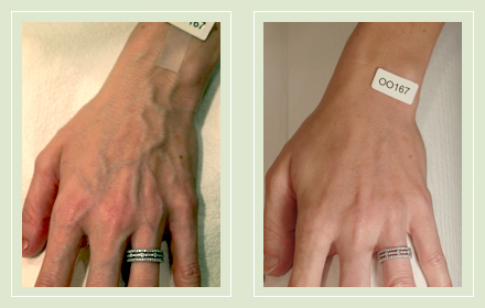 varicose-hand-vein-removal-before-after-pics-3