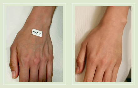 hand-vein-removal-before-after-pics-3