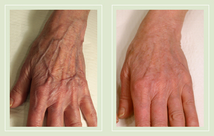 hand-vein-removal-before-after-pics-11