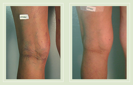 before and after pic reticular spider vein sclerotherapy 56yo