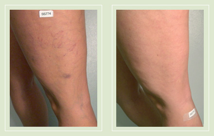 Before and after leg spider reticular vein sclerotherapy 56yo