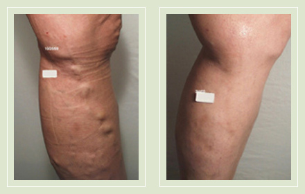 before after pictures varicose vein treatment legs-18